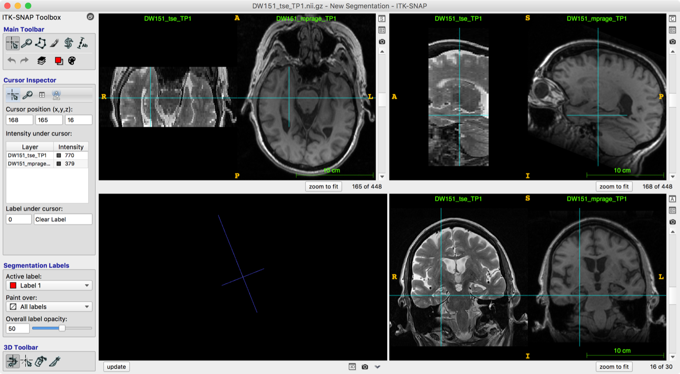 ITK-SNAP with T2 and T1 images loaded