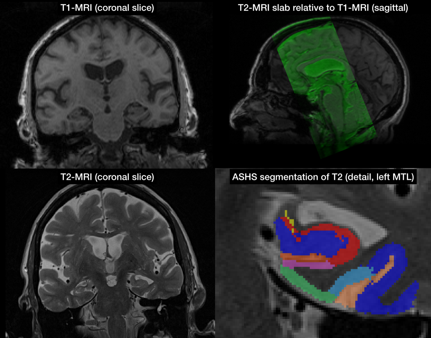 Input data and segmentation for the ASHS-PMC atlas
