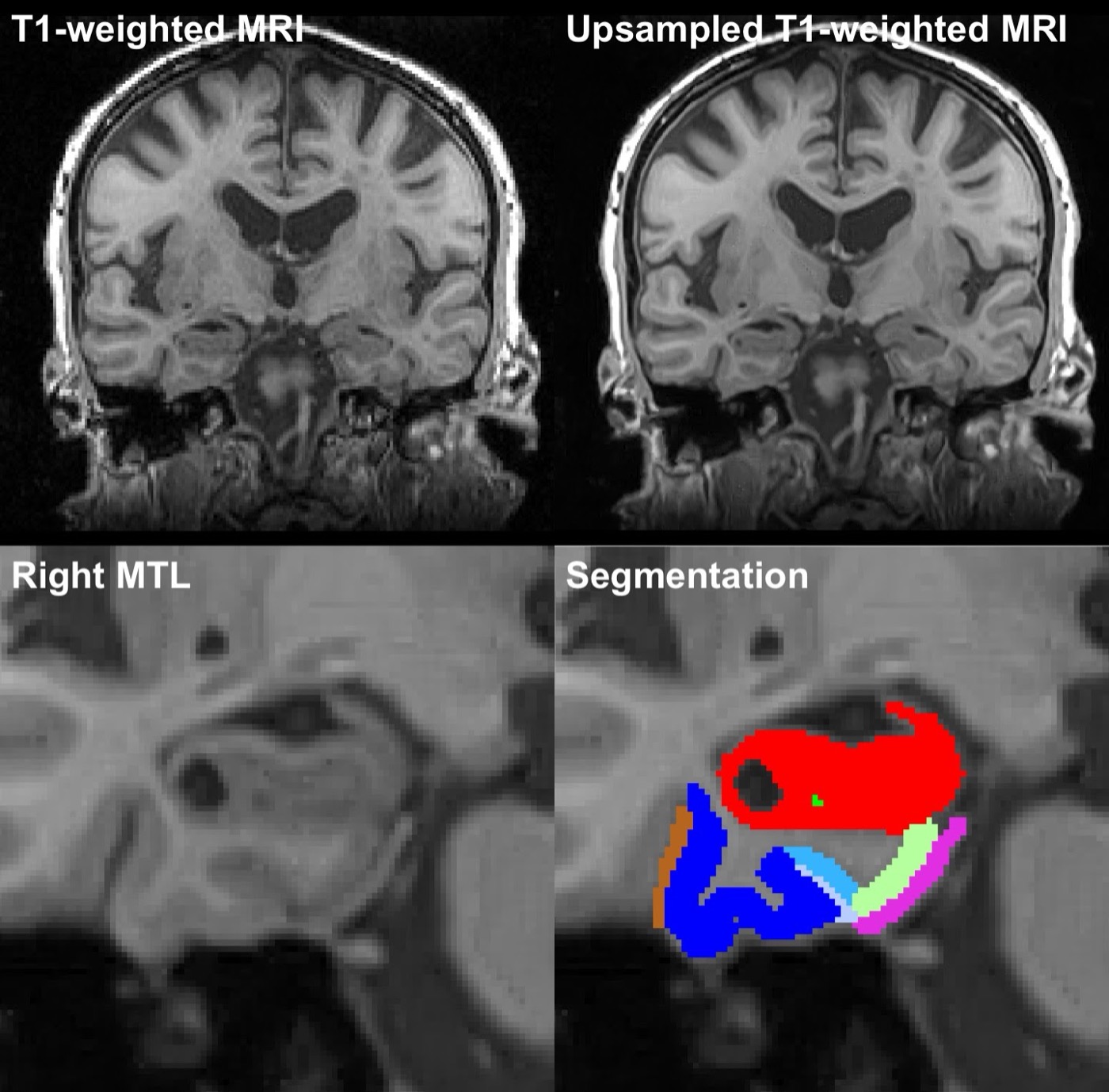 Input data and segmentation for the ASHS-PMC-T1 atlas