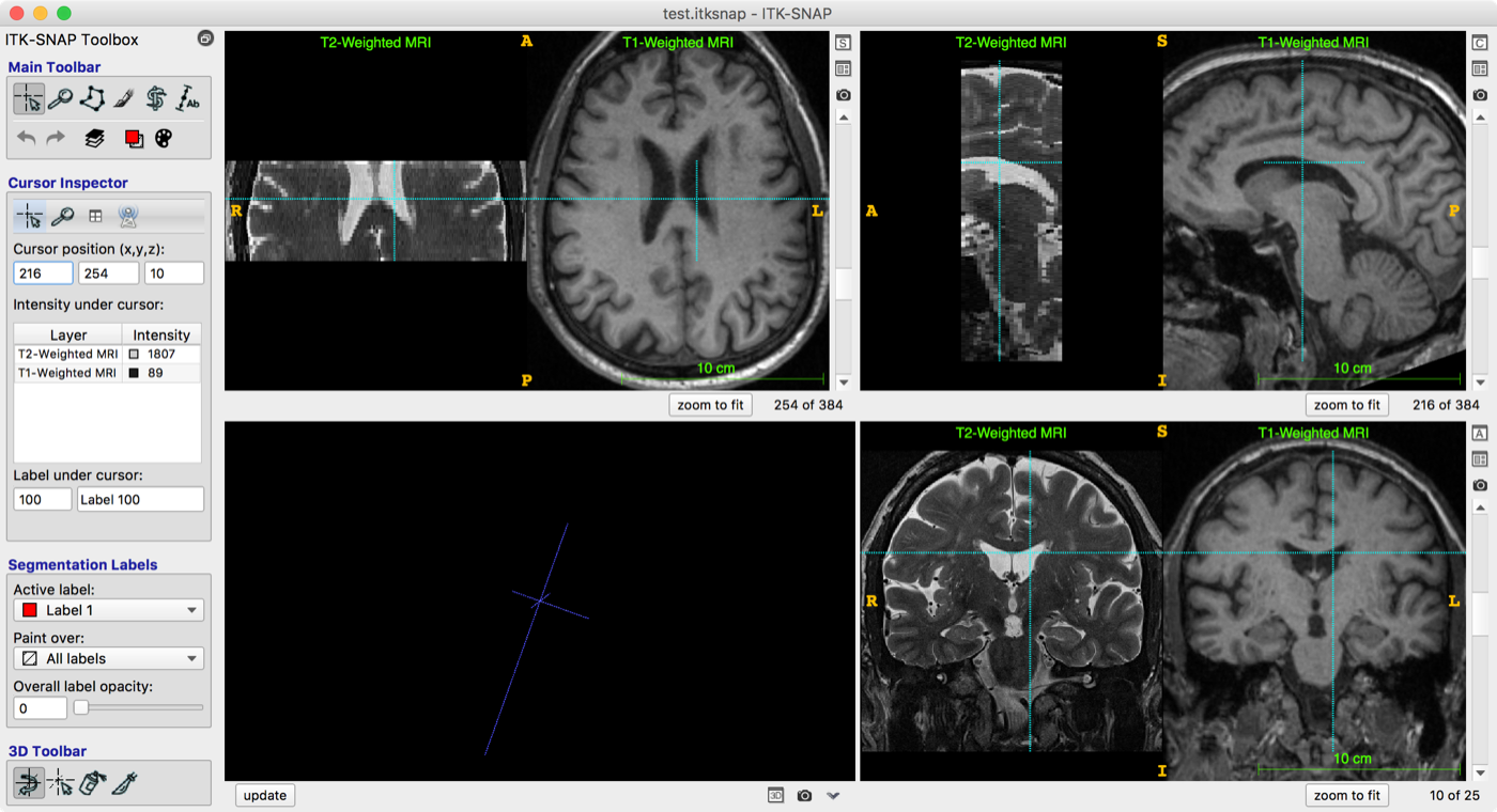 T2 and T1-weighted MRI side by side in ITK-SNAP