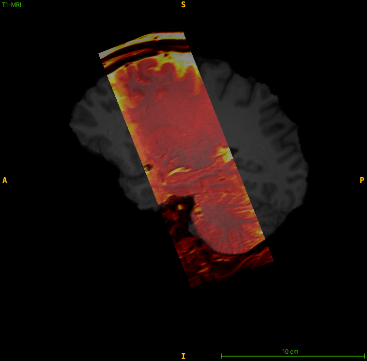 T2w slab position on a sagittal T1w slice