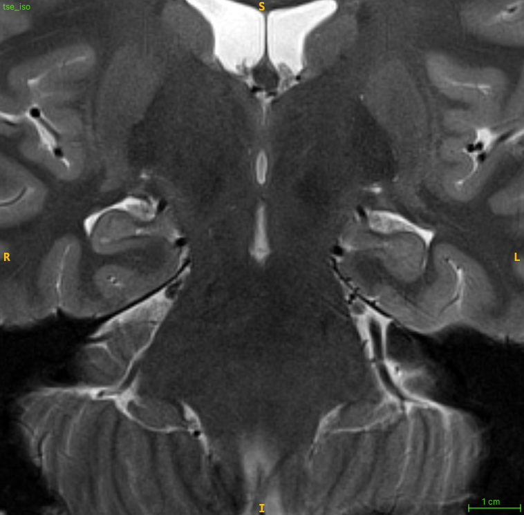T2-weighted input image