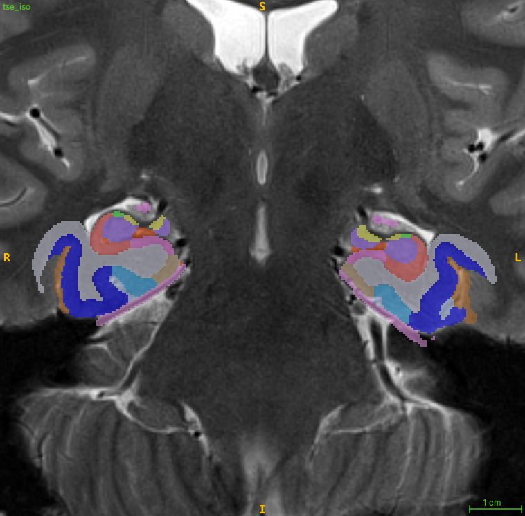 PMC_Atlas segmentation