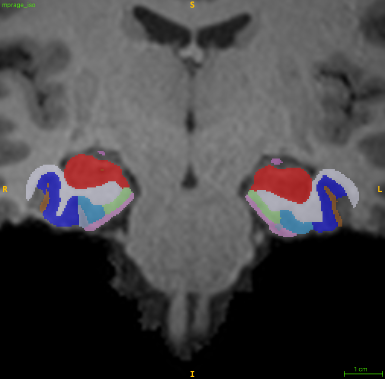 PMC_T1_Atlas segmentation